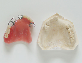 従来の一般義歯