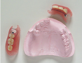 ノンクラスプ床義歯